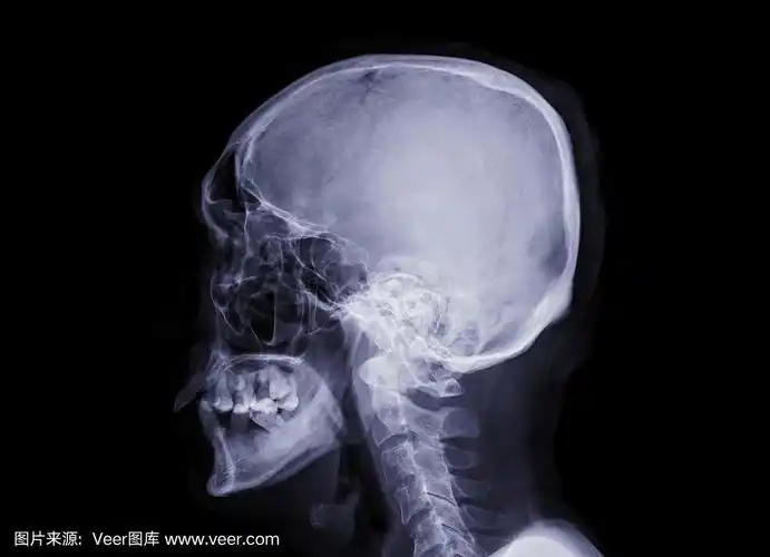 颅骨x线图像的人颅骨侧面孤立在黑色背景.