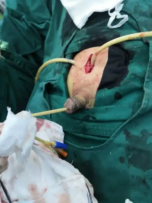 前列腺手术案例_尿道