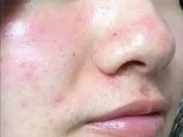 食用_脸部_过敏原