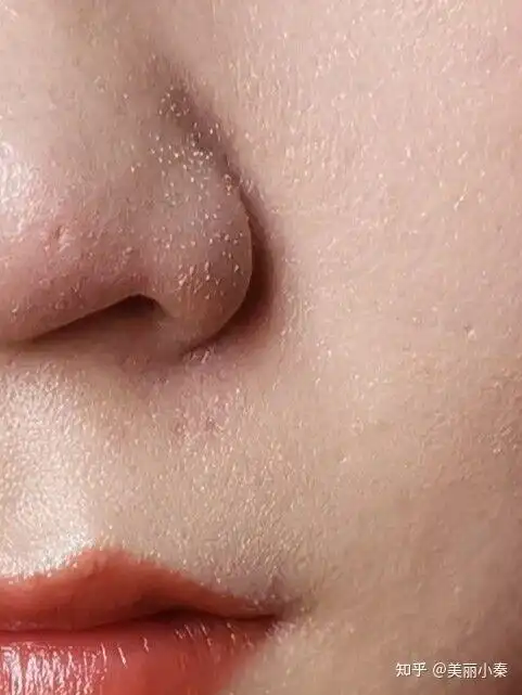 同事一个个好精致!而我鼻子黑头超严重,感觉鼻子像塞满了芝麻!求助乳