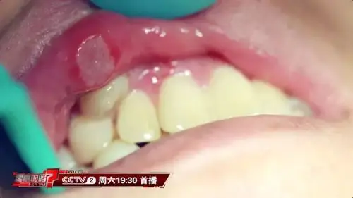 千万别大意|口腔溃疡|溃疡|口腔癌_新浪新闻