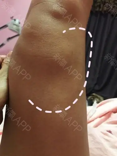 右腿凹陷明显…… 凹陷侧面明显右腿～～92_圈子-新氧美容整形