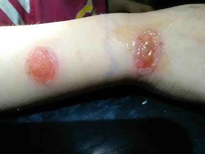 请问我弟弟生什么了?怎么皮肤溃烂了?