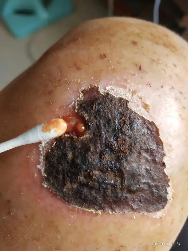 结疤一个星期了不脱疤!疤都硬得像石板,手一按里面是空的,弄开 - 抖音