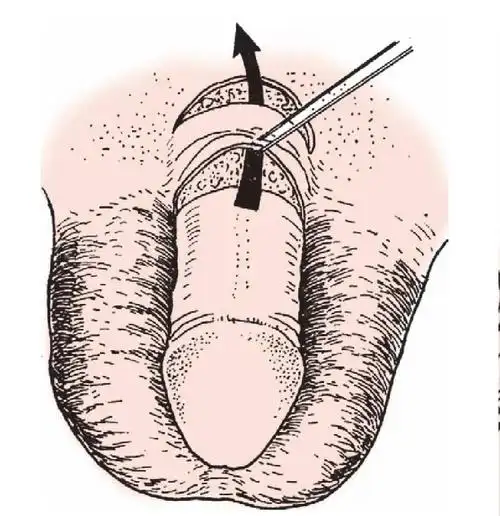 二, 阴茎正位切口矫形术-泌尿外科手术-医学