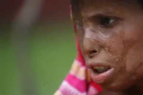 脸部严重烧伤图片 - 搜狗图片搜索