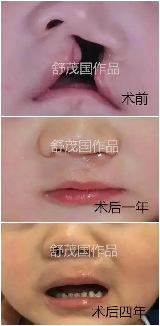 单侧完全唇裂手术治疗