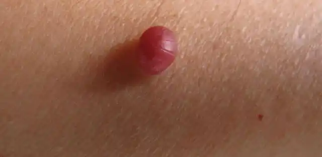 多做了解(一)病因概述樱桃血管瘤是一种良性的表观遗传毛细血管肿瘤