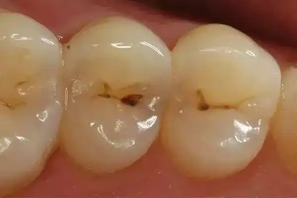 牙齿从针眼大的洞到拔除过程