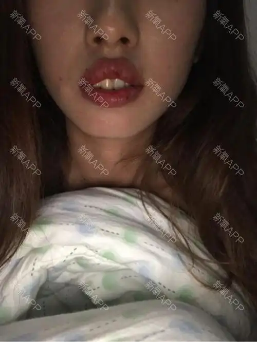 我牙骨突出上嘴唇外翻并且上下嘴唇都很厚正常情况是闭合不了的笑起来