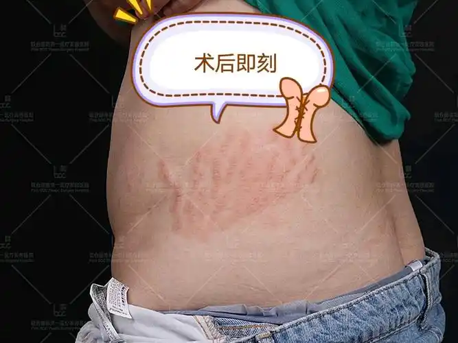 妊娠纹治疗术后第1天