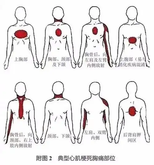急性心肌梗死疼痛的部位在心前区和或胸骨后,表现为突发性胸骨后或心