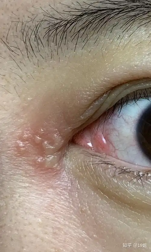 左边内眼角皮肤起水泡怎么办