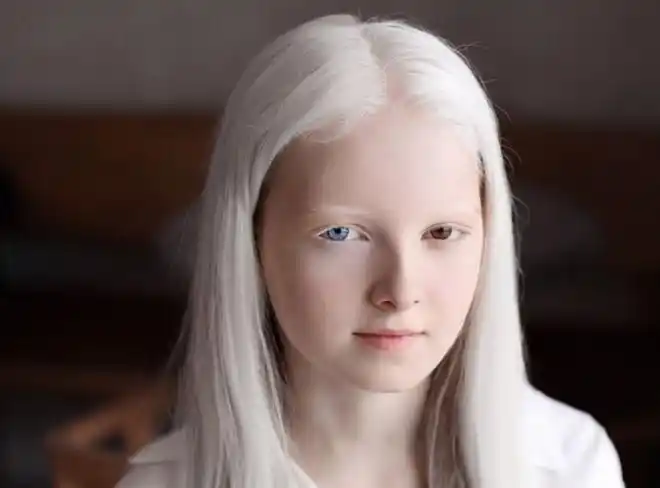 非洲现实版"唐僧",血液堪比黄金,警察24小时贴身保护|白化病|人种