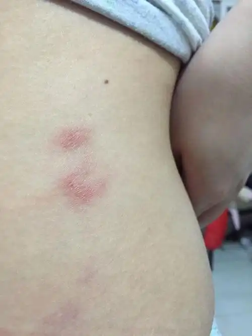 前几天身上起了这样的包,痒,挠完之后就这样了,好像是被寝室床上的