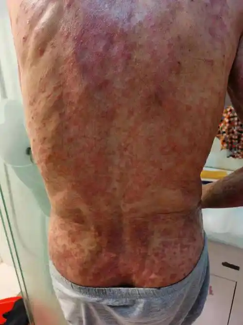 皮疹痒的不得安宁,医生最后采用激素疗法也压不下去,全身皮肤都快溃烂