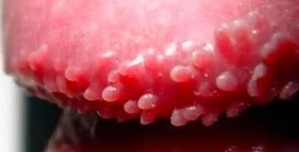 淋病早期症状症状,多考虑为非淋菌性尿道炎或淋菌性尿道炎的早期反应