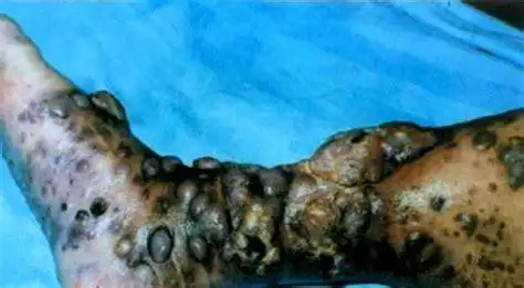 男人得了性疾病有哪些症状男人得了性疾病有哪些症状图片