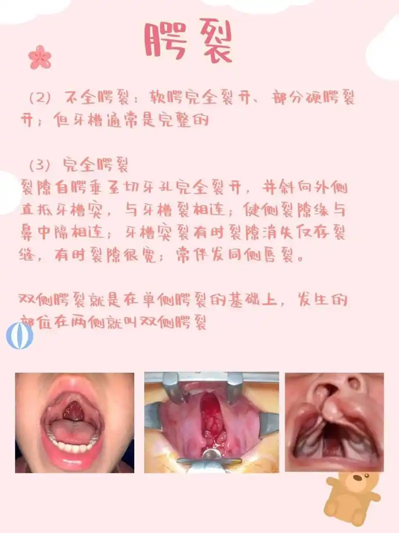 唇腭裂基本认知:腭裂的类型(接上) 根据裂隙的部位,腭裂分为单侧,双侧