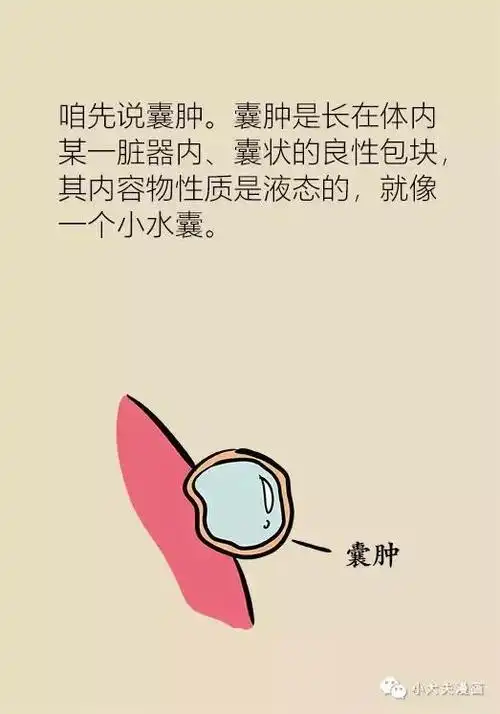 体检查出囊肿,结节,息肉,是不是癌症先兆?