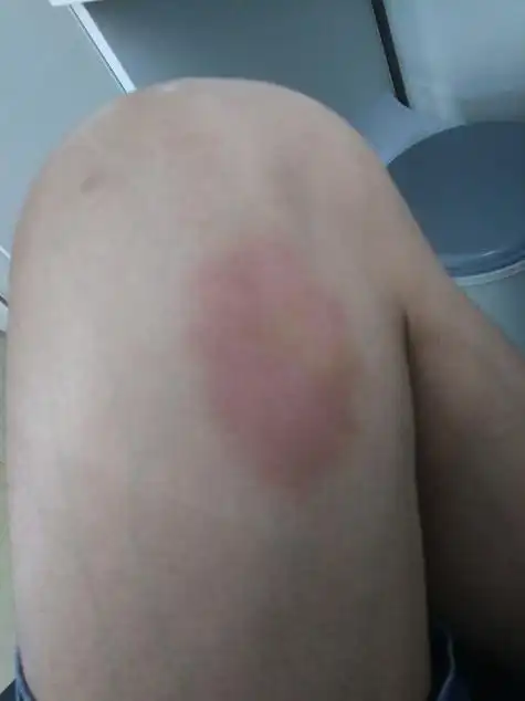 腿摔淤青了怎么办 腿摔的淤青了怎么办