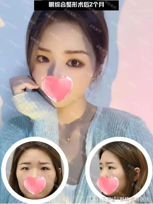 郭栋双眼皮整形切开重睑内眦赘皮矫正提肌矫正术后2个月效果