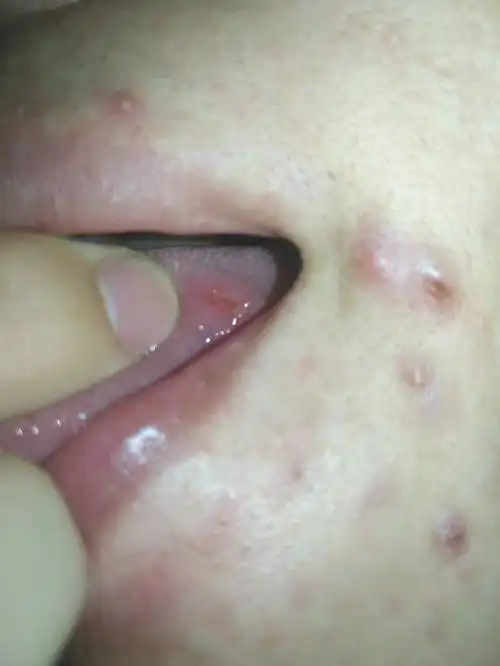 舌头起了个泡然后越来越痛了咋办