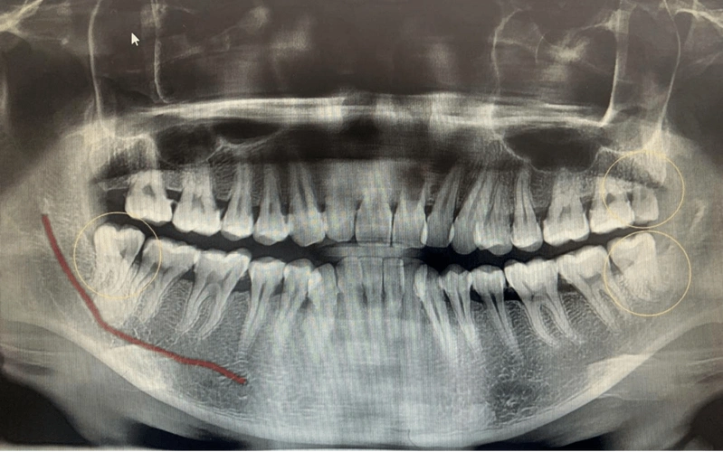 看牙拍片子真的很必要