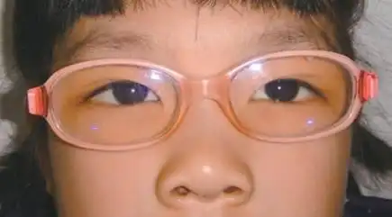 儿童弱视勿忽视