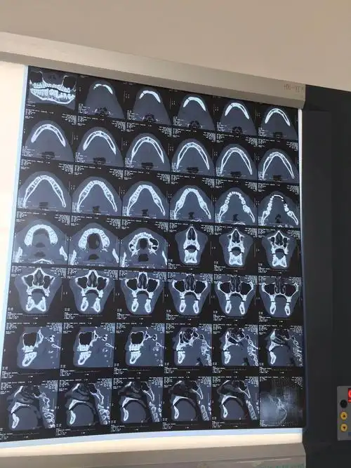 大荔县医院麻醉科成功完成一例下颌骨骨折经鼻盲探气管插管!