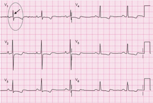 纯干货,系统解读心电图的9个步骤 |心电图学习一日通