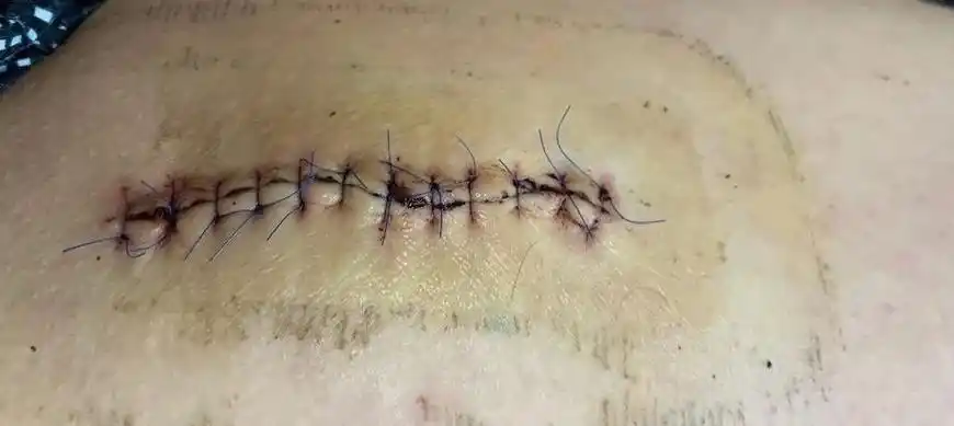 手术后医生从我腿上切下了一颗殷红色的墨鱼蛋