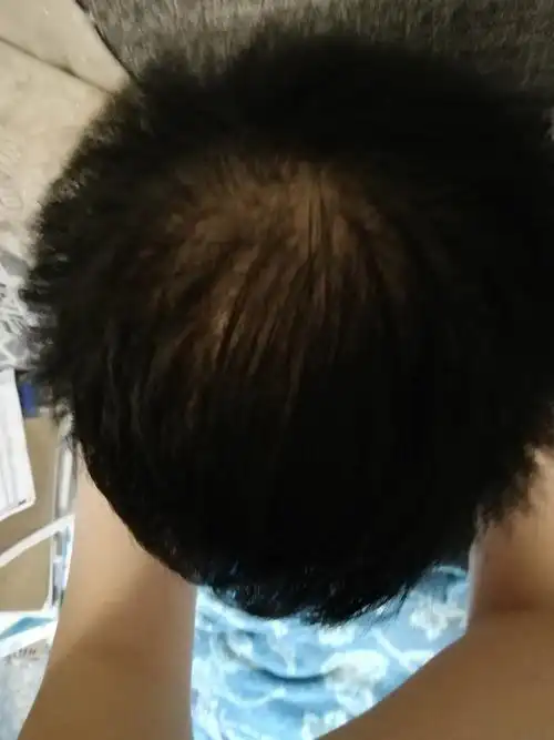 17岁秃顶了咋整