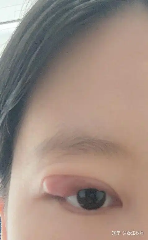 霰粒肿,如何避免手术?