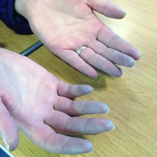 雷诺现象的一种极端病症,这种病症使她不断遭受"寒冷"之苦,她的手指和