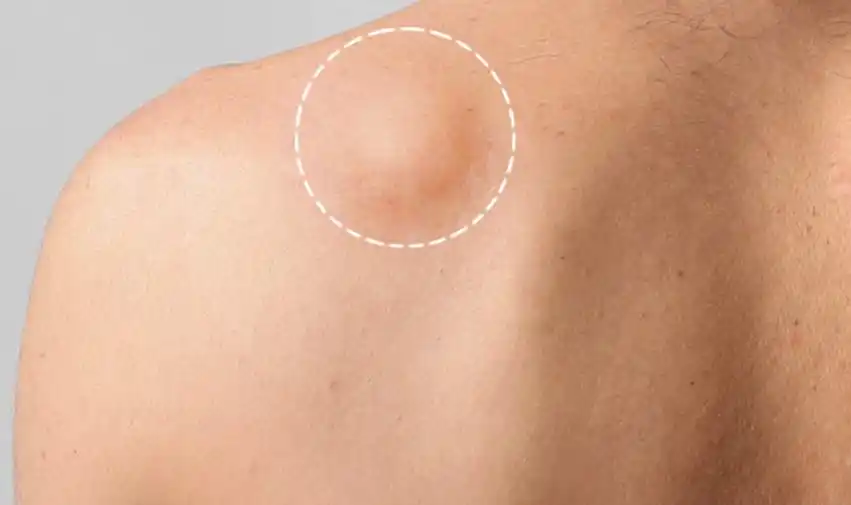 为什么我们会长脂肪瘤,它会恶变吗?必须手术治疗吗?医生告诉您