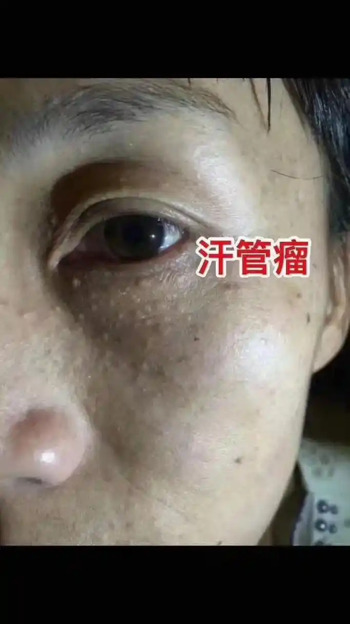 脸黄疣=脸黄瘤,中年人多见,尤其是女 血管痣 睑黄疣 汗管瘤 - 抖音