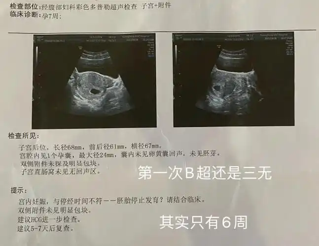 医生判断可能是胚胎停止发育,说按照停经时间和孕囊大小看应该是会有