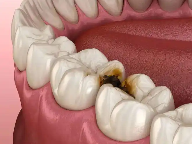 牙缝间出现的蛀牙▼要是再严重点的,甚至还会出现邻面龋——牙缝间的