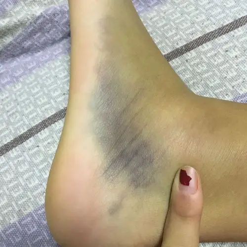 脚脖子外摞骨折半个月把拆石膏了 这是怎么回事呀