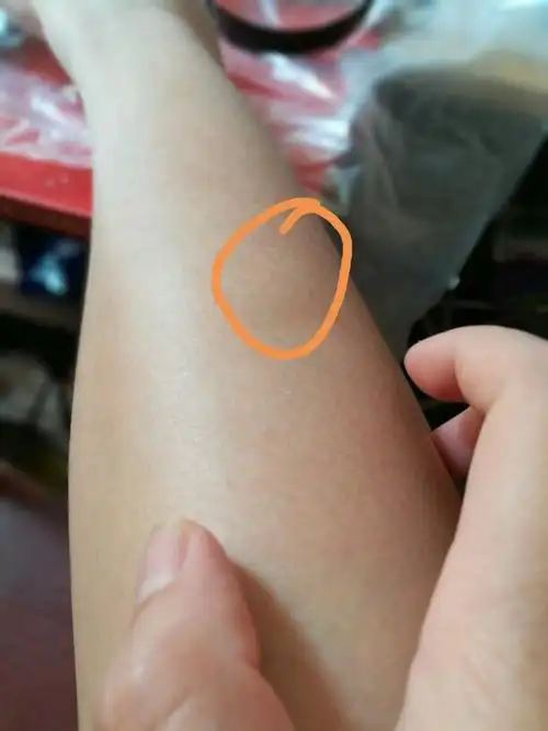 小腿背上长了一个包.