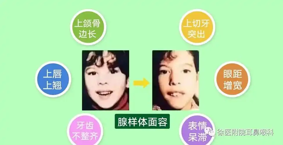 越长越丑睡觉打呼噜张嘴呼吸警惕腺样体面容