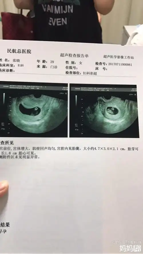 孕囊能看出男孩女孩吗 孕囊看男女其实并没有合理的依据准妈妈们的