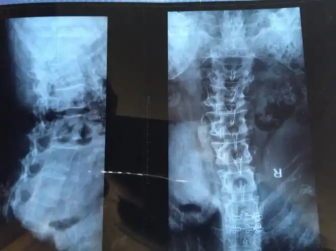 可能扭伤了,去医院拍个片子吧  追问 前天拍的片子,医生说是腰椎侧弯