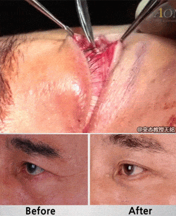 眼角下坠手术:没有精神的眼睛立刻有炯炯有神了