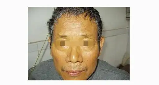 黄疸最常见于肝胆疾病,一般在肝癌的晚期出现,肝细胞性黄疸特征是皮肤