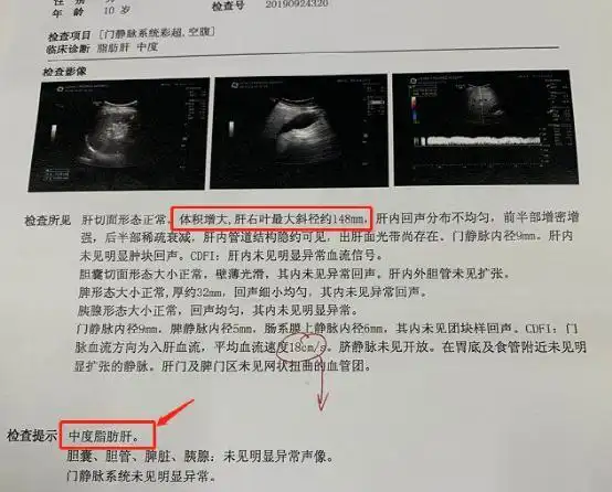 伤肝排行榜第一居然不是熬夜喝酒你可能平时经常做