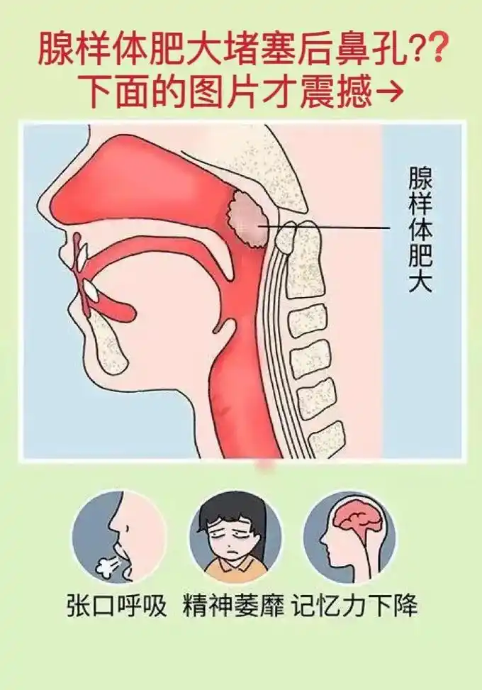 几张图告诉你,腺样体肥大,到底能有多大!#腺样体肥大  #打 - 抖音