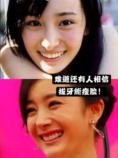 杨幂牙齿内倾的教训告诉你,拔牙并不能瘦脸
