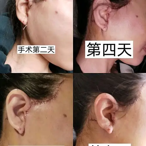 000000小切口拉皮